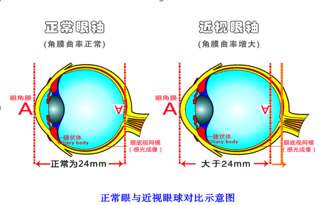 近视眼成因原理 - 新闻资讯